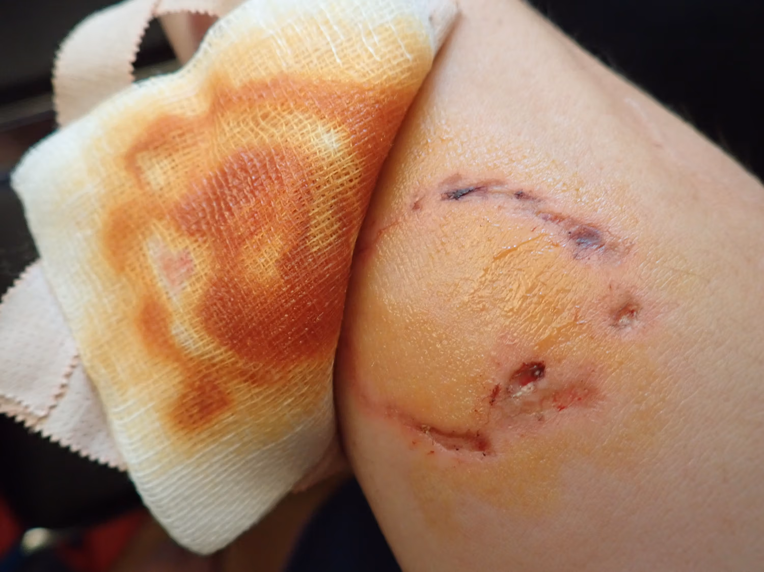 North Charleston Dog Bite Lawyer — Cannon Law Firm